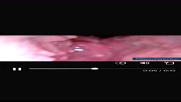 クスコ  子宮膣内丸見 2