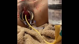 japanese girl gets water in her bladder through cathete