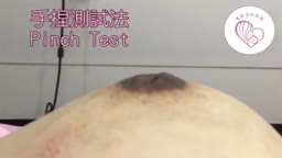 inverted nipple pinch test