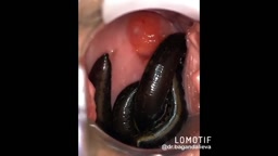 Leeches eating vagina